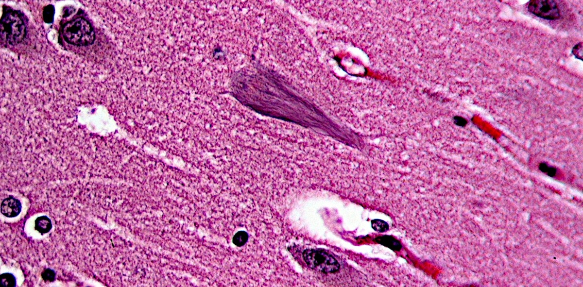 Нейрофибриллярные клубки в структуре головного мозга гиппокампа у пожилого человека с патологией, характерной для болезни Альцгеймера.  © CC BY-SA 3.0/Patho