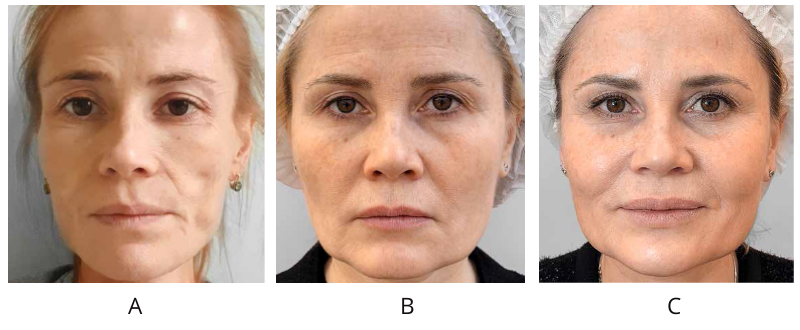 Пациентка, 47 лет. А — исходное состояние, на пике минимального веса (35,6 кг); B — после набора веса (54 кг) и работы с психотерапевтом, до начала косметологических процедур; C — результат через 30 дней после завершения протокола.