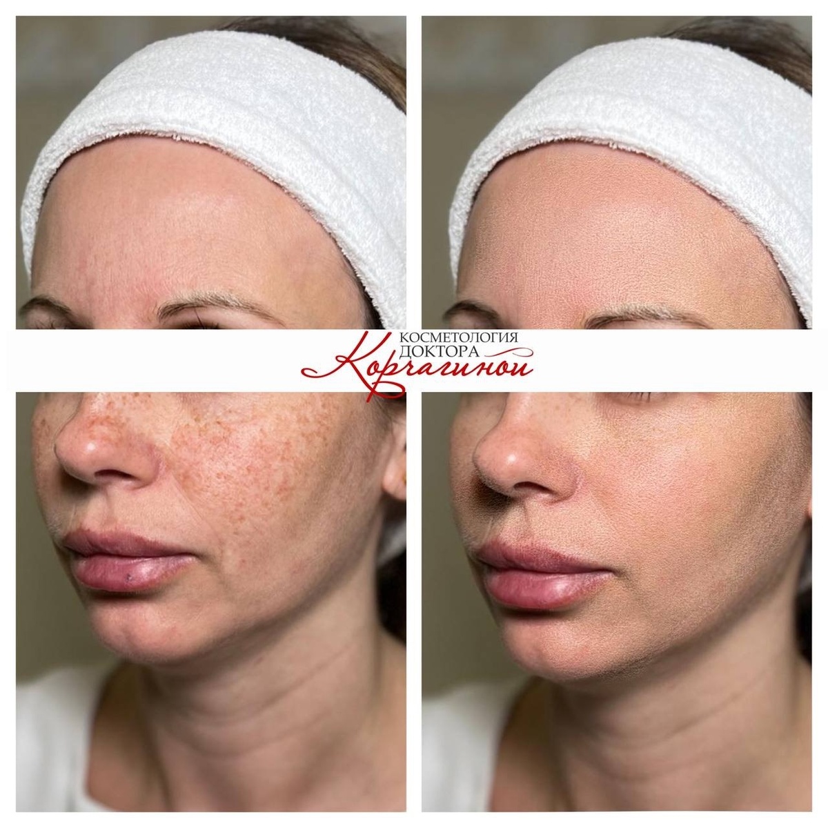 Фото до и после курса процедур и фотоомоложения .