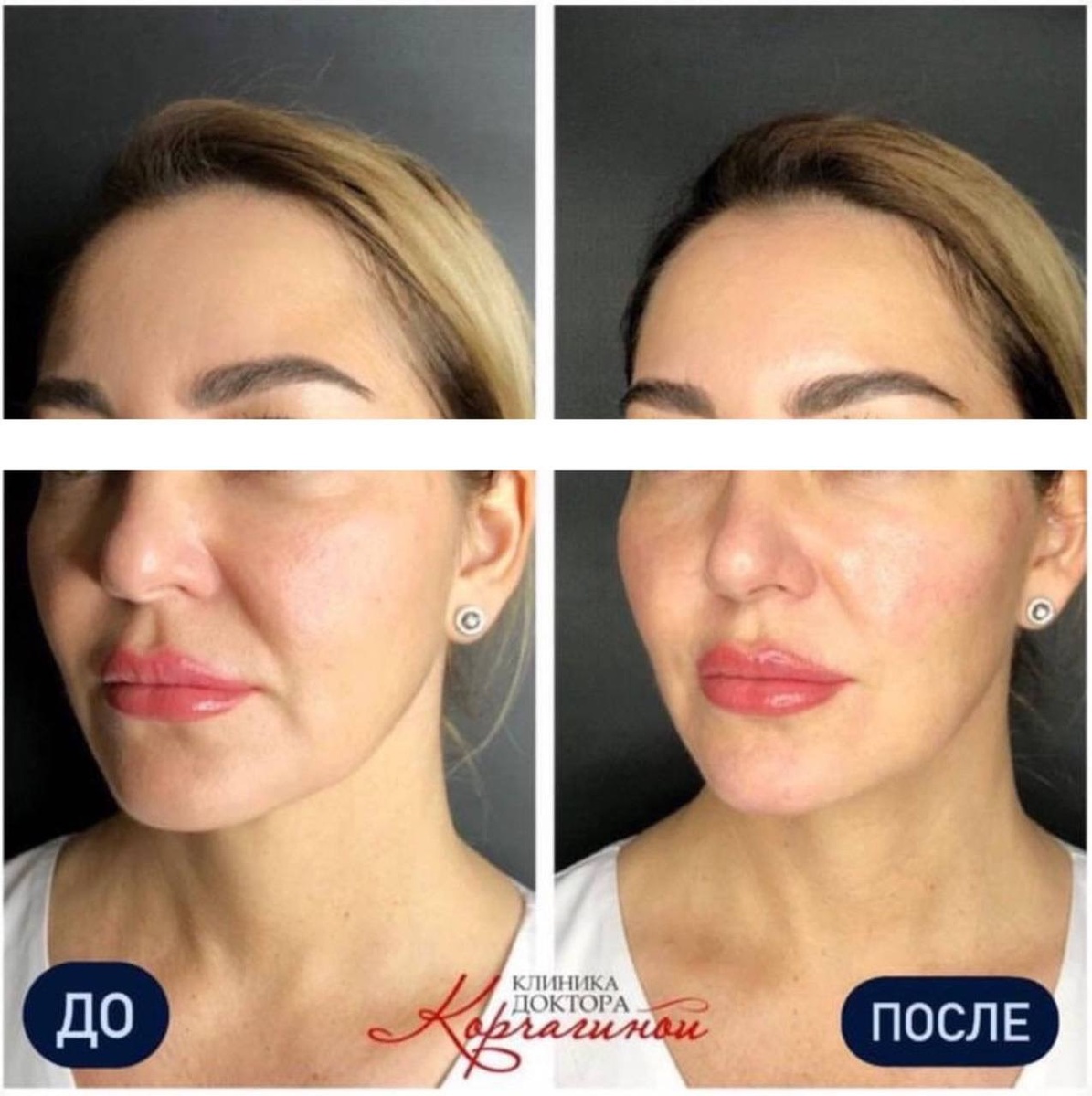 Фото до и после нитей Aptos. 