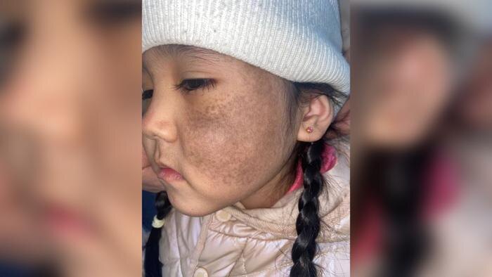 Так выглядело лицо Арины до лечения. Фото © Предоставлено Life.ru