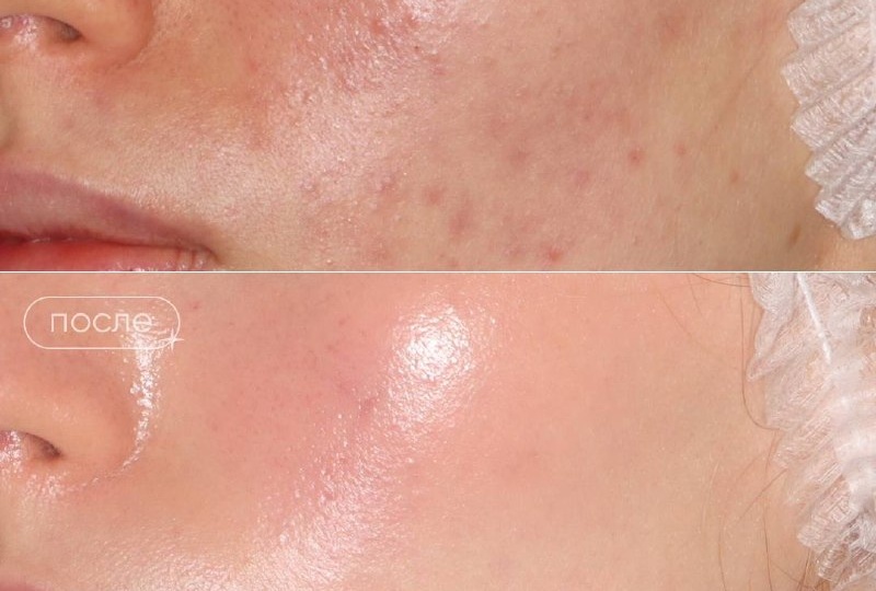 Делимся результатом работы с акне