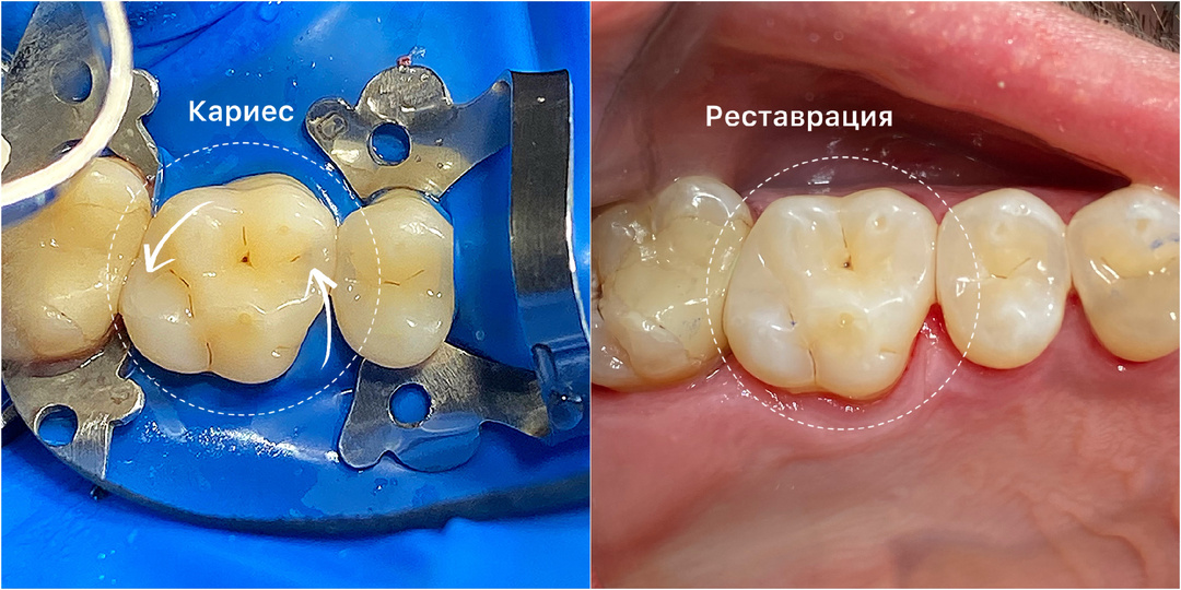 Как выглдяит кариес на межзубных промежутках?