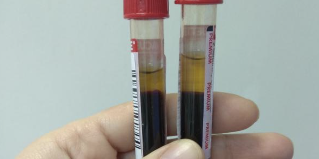 Почему цифра 5,5 в анализе — не приговор, а повод для разумного спокойствия