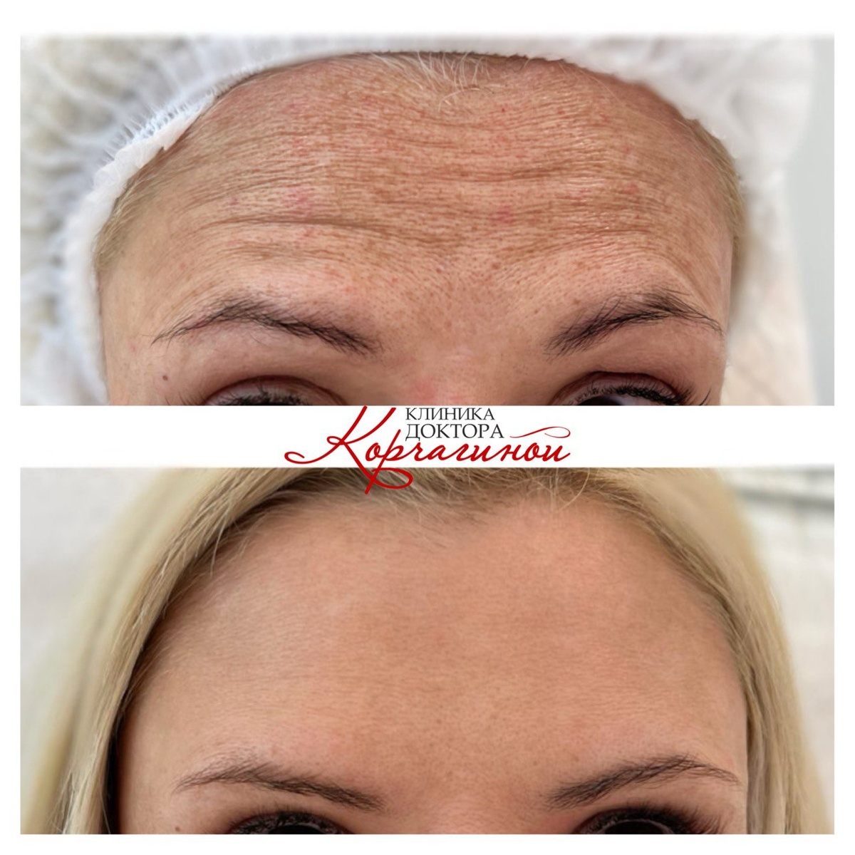 Фото до и после процедуры ботулинотерапии.