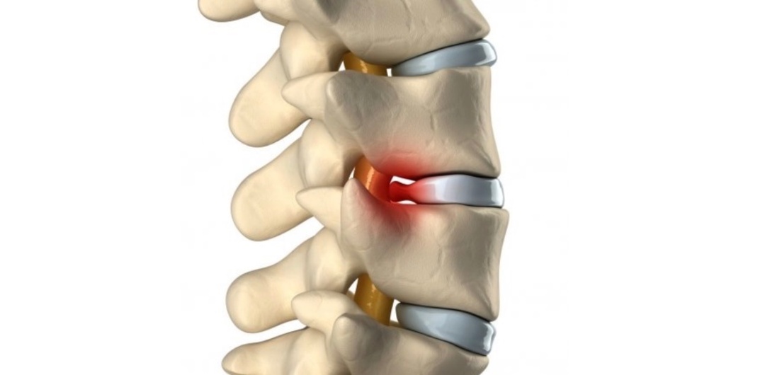 Слабые ноги = больная спина