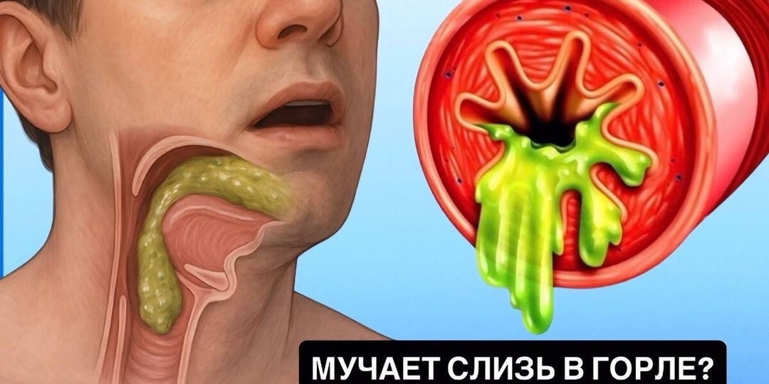 Густая слизь в горле: 3 упражнения и 5 минут в день, чтобы избавиться от кома