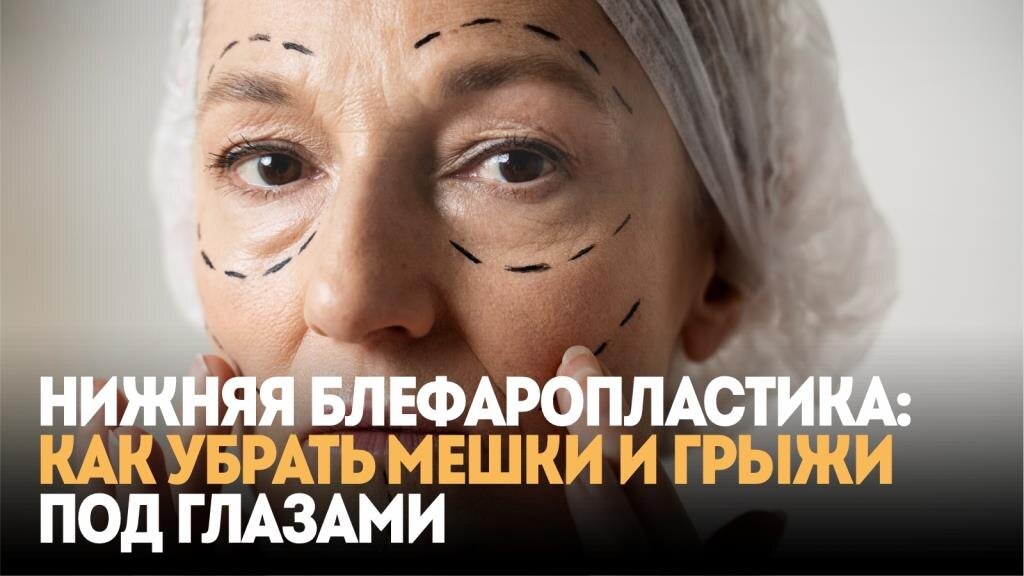 Нижняя блефаропластика: как убрать мешки и грыжи под глазами 