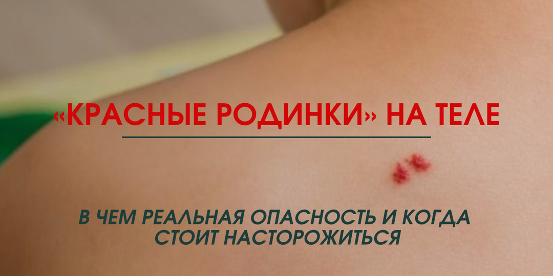 «Красные родинки» на теле, или сенильные ангиомы