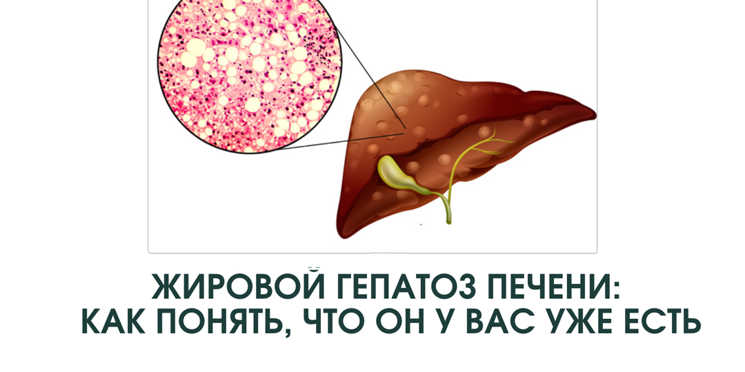 Жировой гепатоз: как понять, что он у вас уже есть
