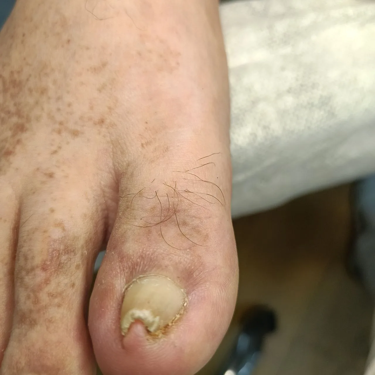 Ониходистрофия