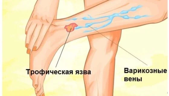 Трофическая язва