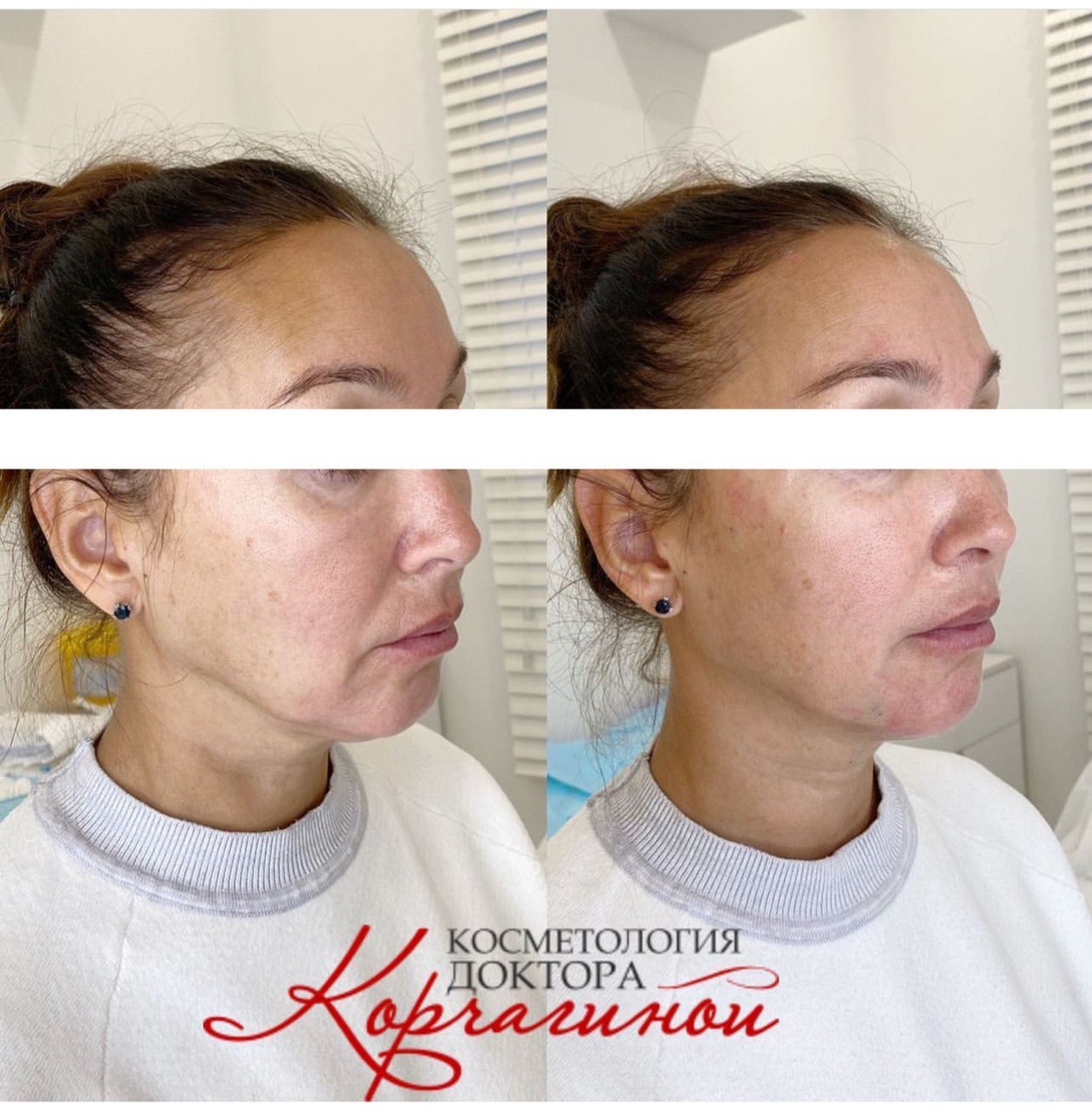 Фото  до и после процедуры SMAS - лифтинга