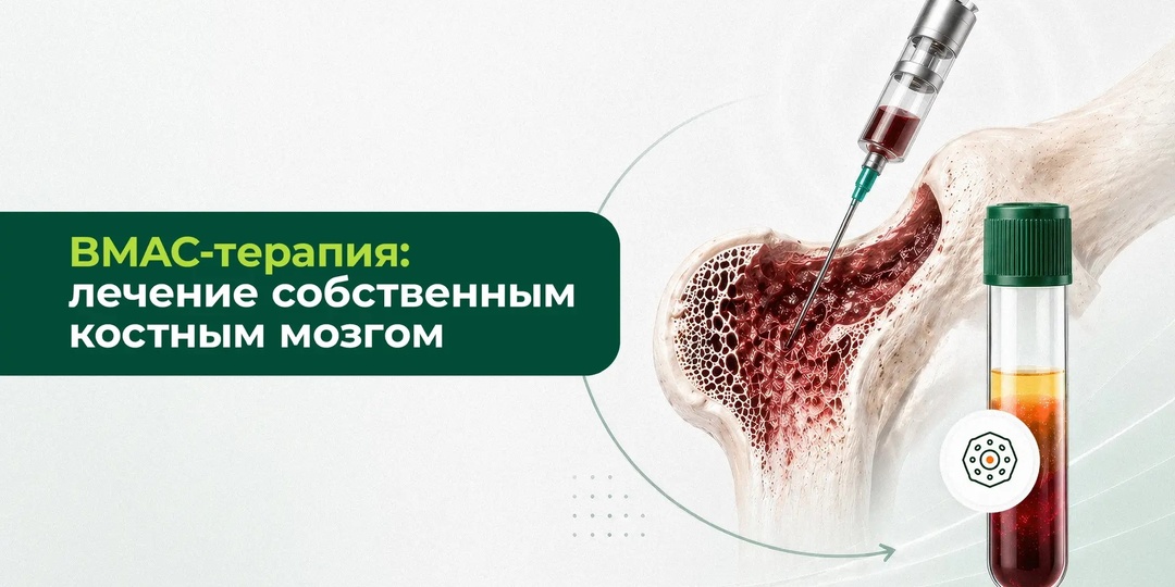 BMAC-терапия: лечение собственным костным мозгом. Чем это отличается от PRP и SVF?