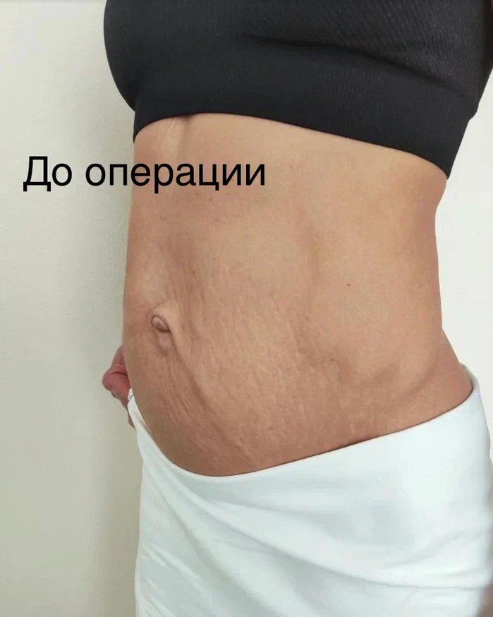 Абдоминопластика, Ухарцев Константин Юрьевич, пластический хирург