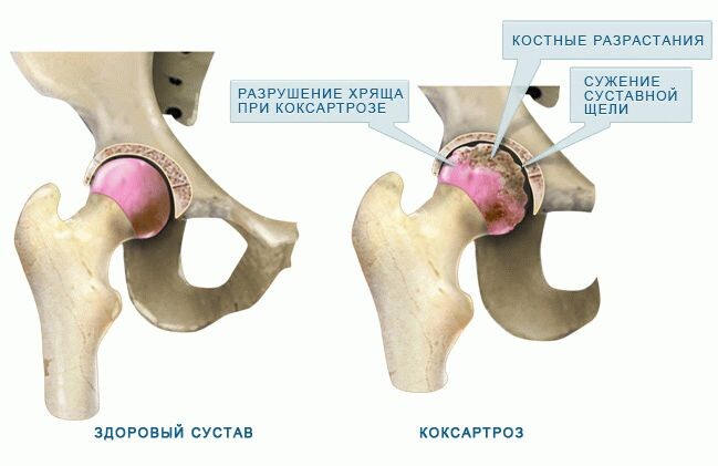 Коксартроз: причины, развитие и профилактика
