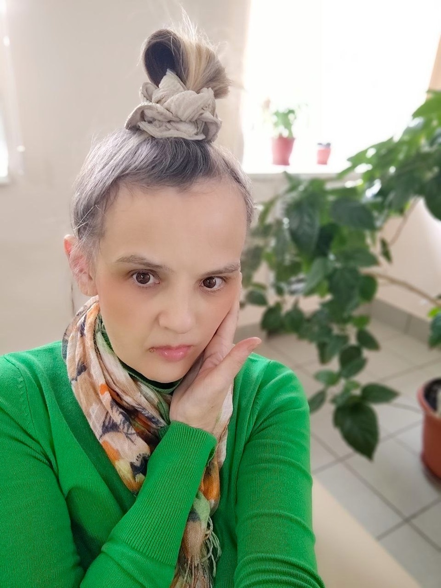 синдром убегающей щеки. Сёдня в клинике после лазера.