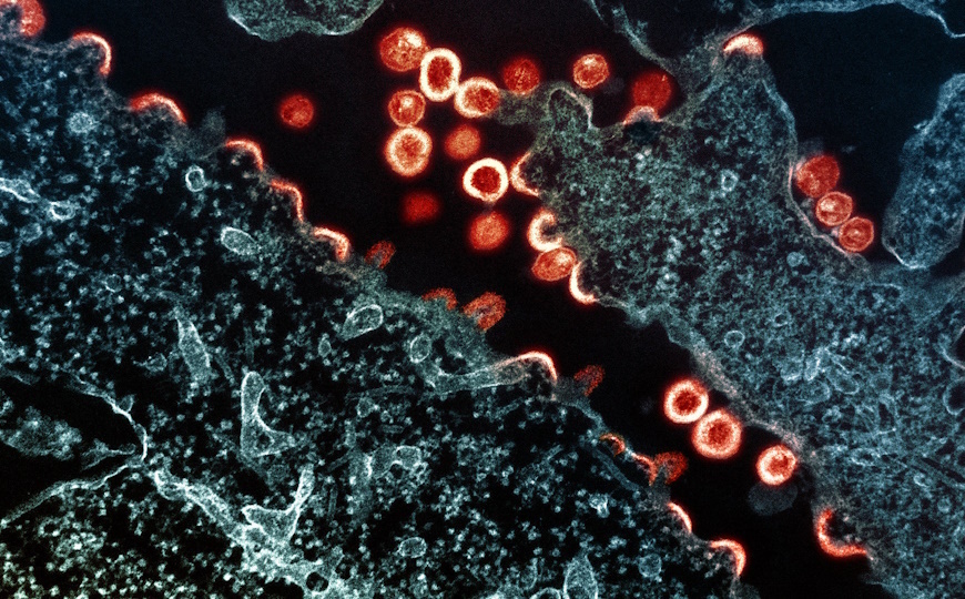 Частицы ВИЧ в инфицированной линии клеток H9. Credit: NIH | flickr.com | Public domain