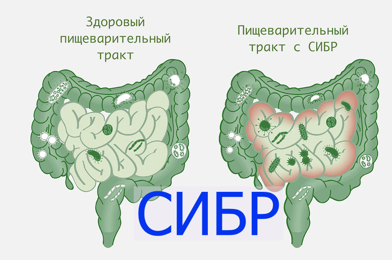 Что такое СИБР и как он отражается на здоровье.