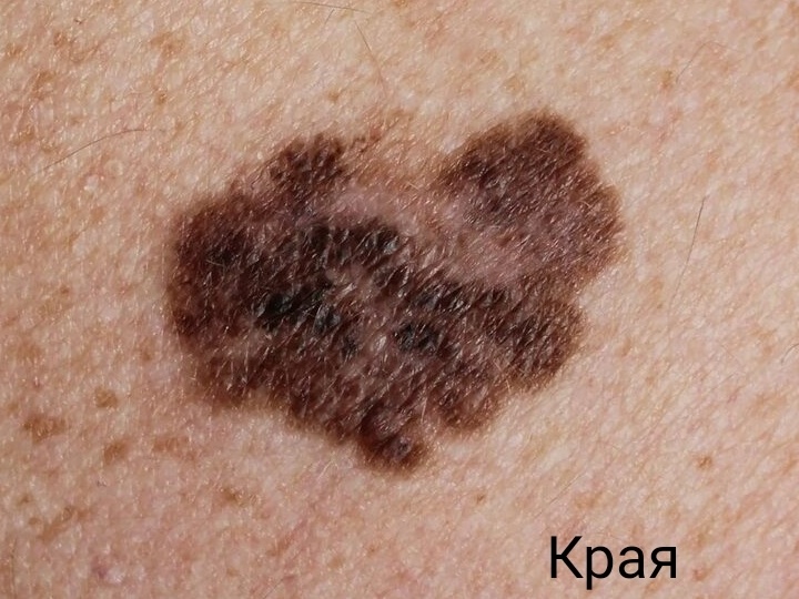 Опасные родинки