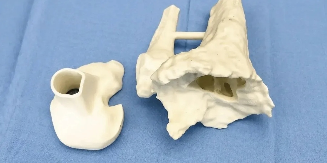Для пациентки сургутского травмцентра изготовили сустав на 3D-принтере