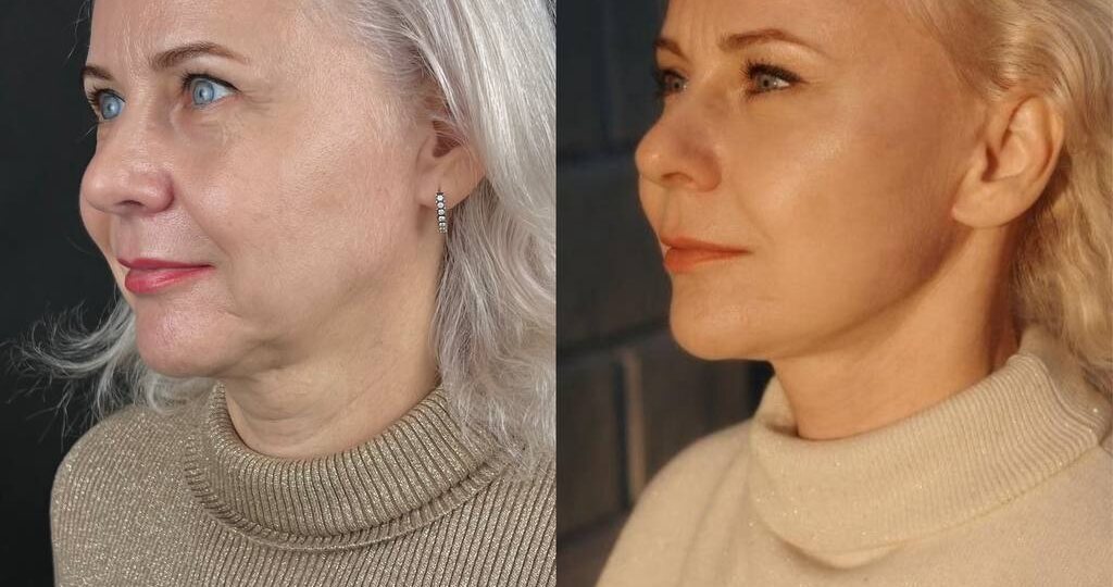 5 месяцев после фулл-фейс омоложения