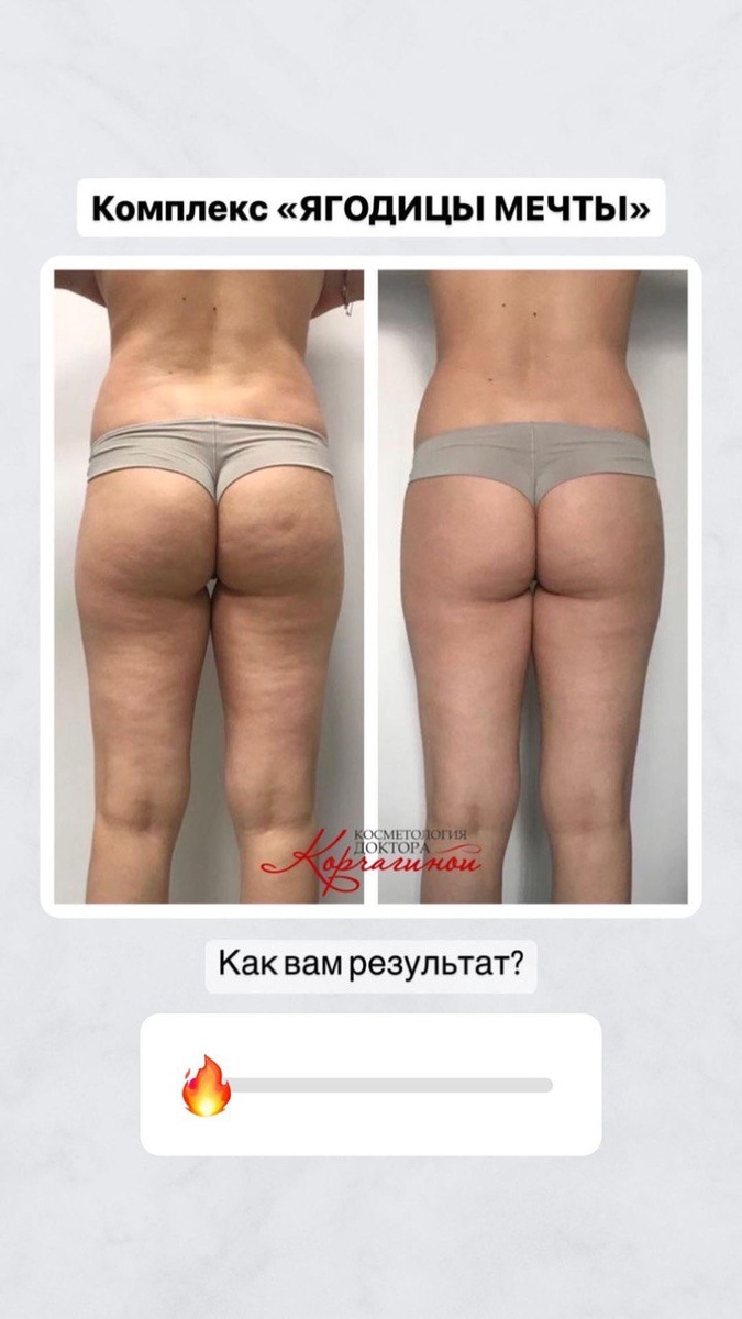 Фото до и после курса процедур . 