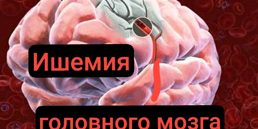 Ишемия головного мозга