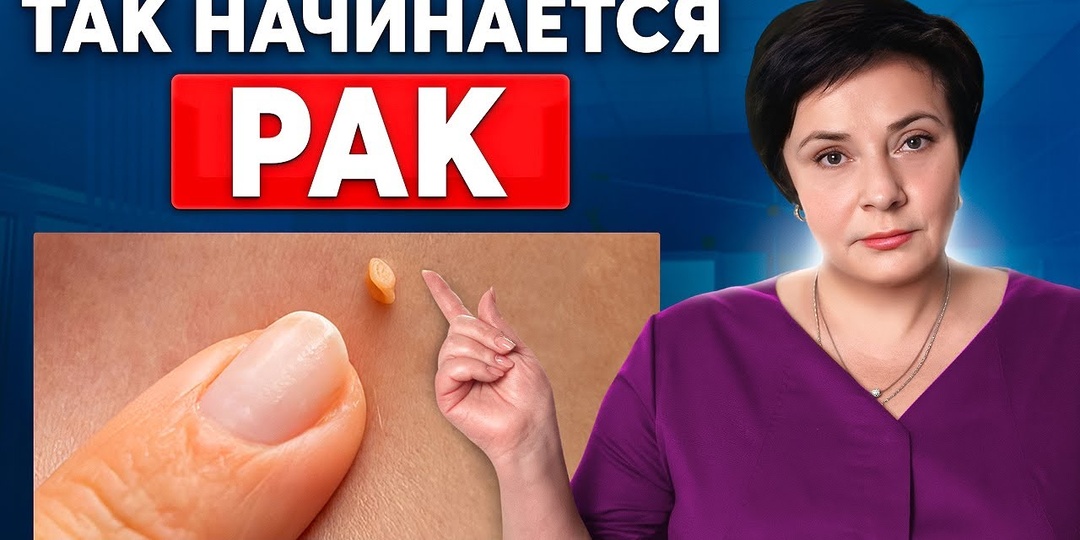 БОРОДАВКИ и НАРОСТЫ — сигнал организма! Вот что на самом деле происходит