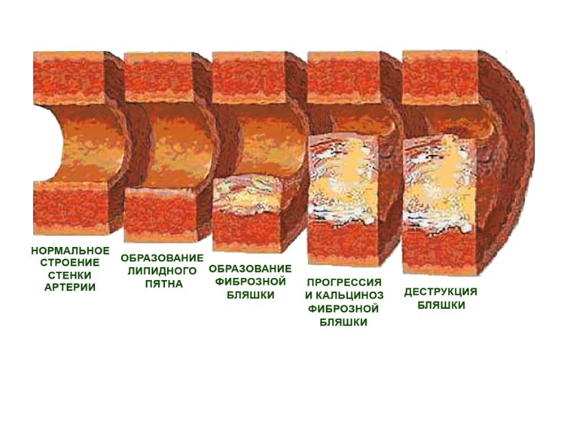 https://yandex.ru/images/search?pos=14&from=tabbar&img_url=https%3A%2F%2Fbariatric.1spbgmu.ru%2Fimages%2FPatogenez%2FAteroskleroza%2FFormirovaniya_ateroskleroticheskoi_blyashki.jpg&text=атеросклероз+картинки+стадии&rpt=simage&lr=62