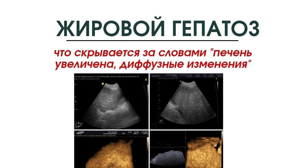 Жировой гепатоз - что скрывается за словами «печень увеличена, диффузные изменения»