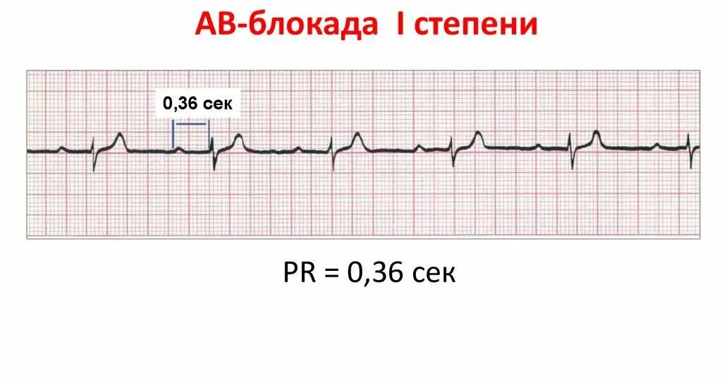 АВ-блокада I степени: что это значит и когда это может быть опасно