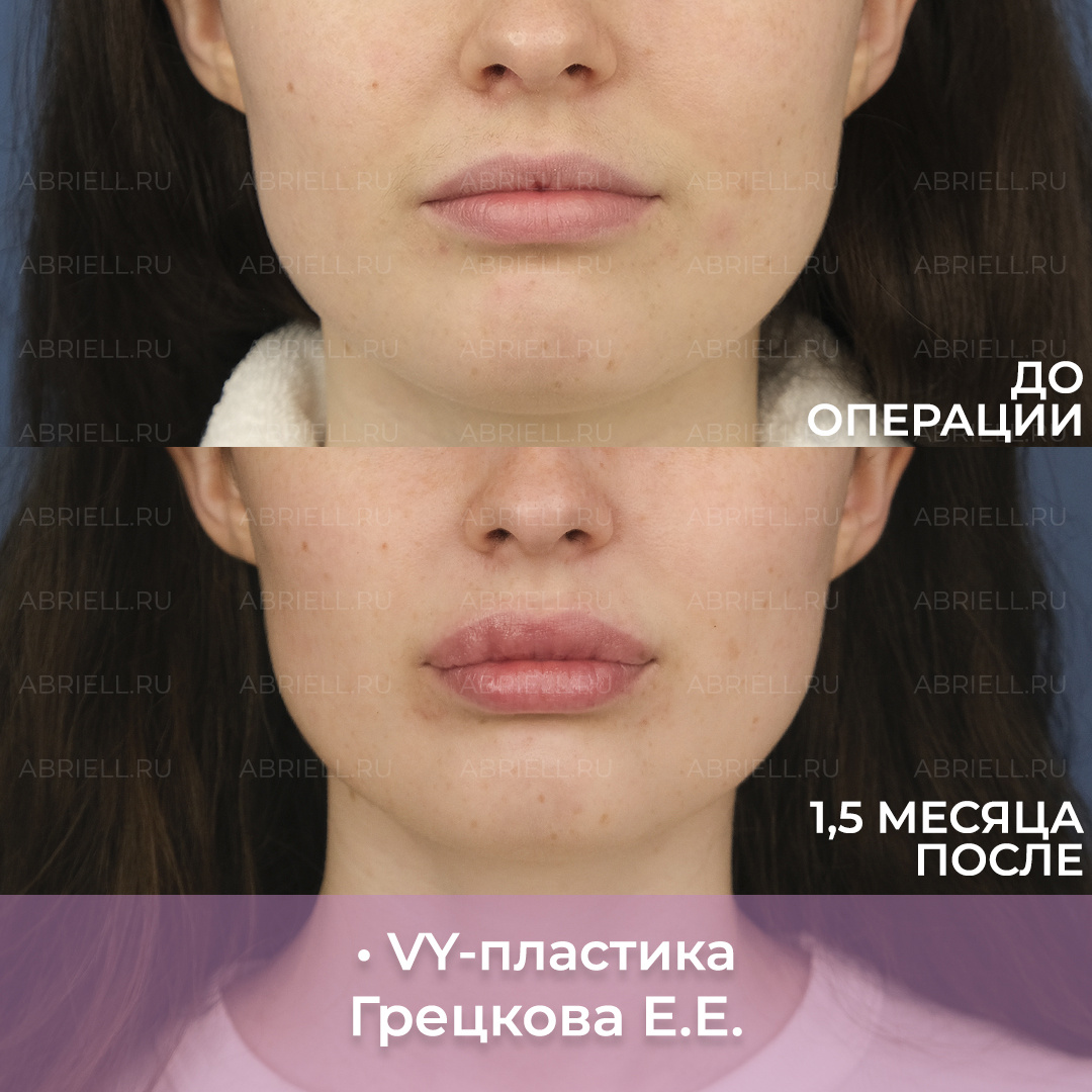 VY-пластика - увеличение губ без филлеров. Пластический хирург в Санкт-ПЕтербурге Грецкова Евгения Евгеньевна Клиника Абриелль