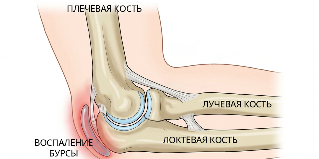 Бурсит локтевого сустава. Что делать?