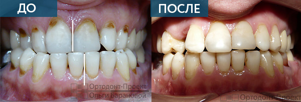 Исправление прикуса зубов ДО и ПОСЛЕ