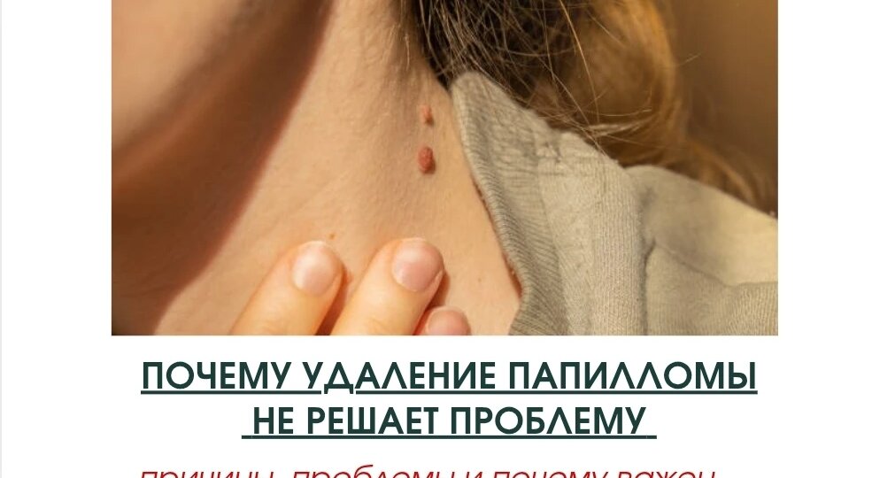 Почему удаление папилломы не решает проблему