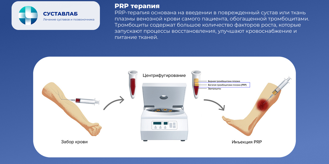 PRP терапия: что это и как она помогает при боли в суставах