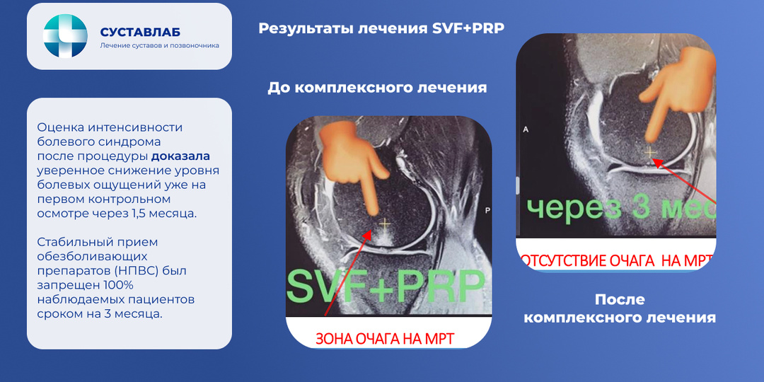 SVF терапия коленного сустава: цена, эффективность и где пройти лечение в Москве