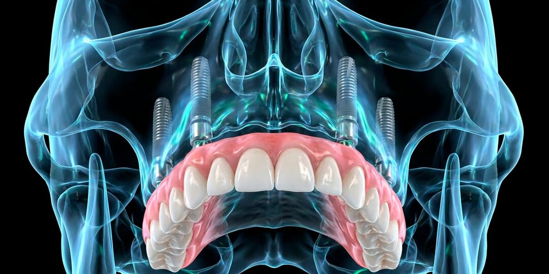 Жизнь с имплантами Zygoma через 2 года: больно ли жевать, как чистить и что чувствуешь — честный отчёт стоматолога