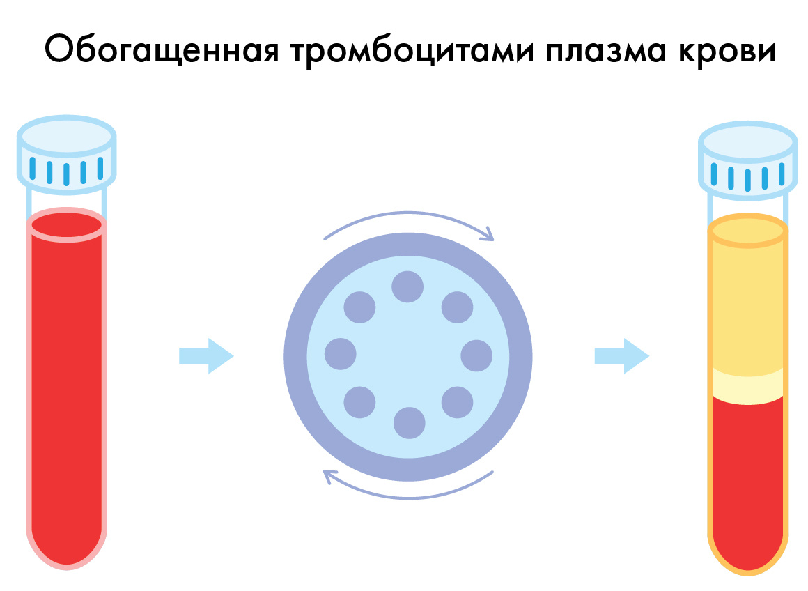 Рис. 1 Получение обогащенной тромбоцитами плазмы
