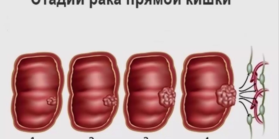 Какие Симптомы Рака Кишечника Появляются У Женщин На Ранней Стадии