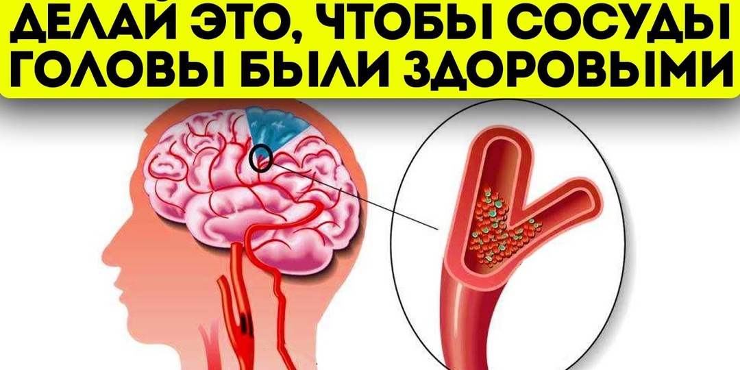 Какие Симптомы Могут Говорить О Сужении Сосудов Мозга