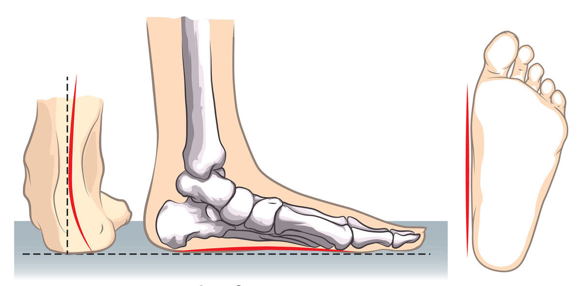 https://cdn.shopify.com/s/files/1/0718/4269/files/Insoles-for-Flat-Feet.jpg