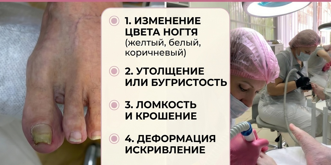 Грибок ногтей: скрытая опасность и как распознать врага на ранней стадии