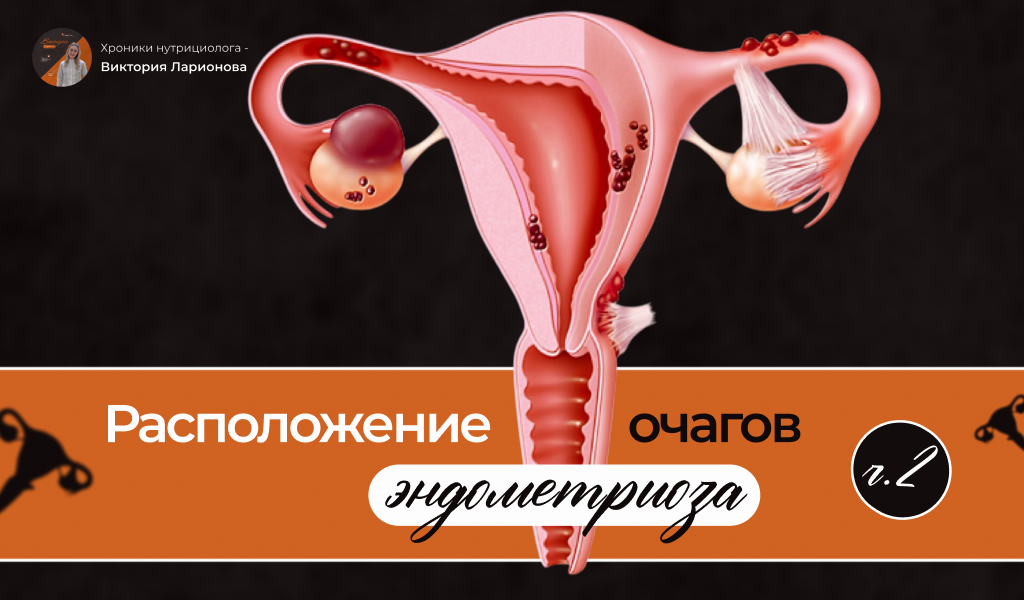 Обложка для поста эндометриоз симптомы и проявление 