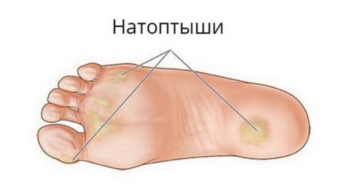 Где могут появляться мозоли