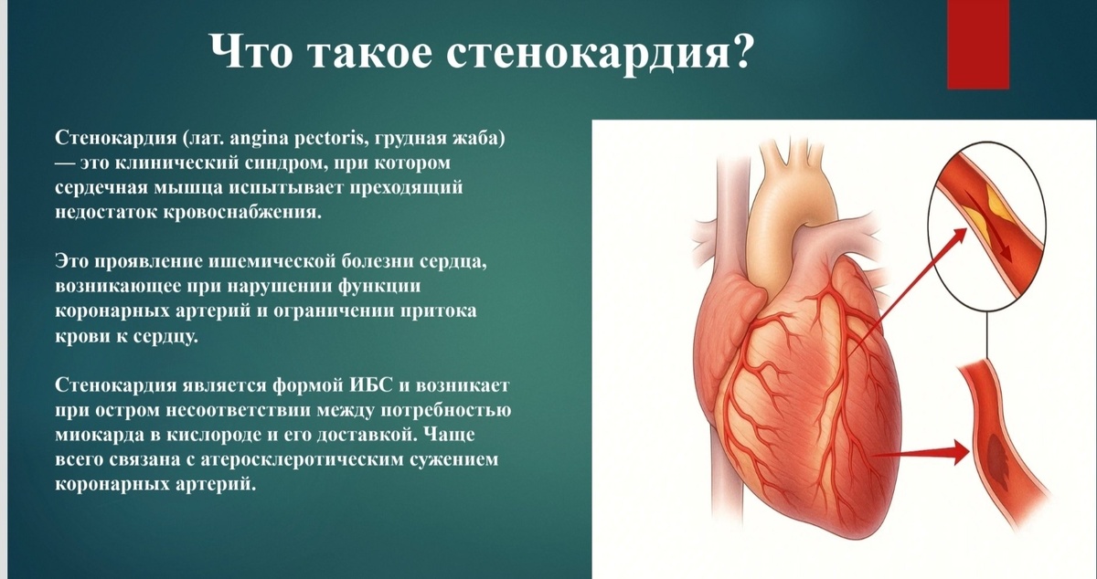 Prosto o medicine. Stenokardiya