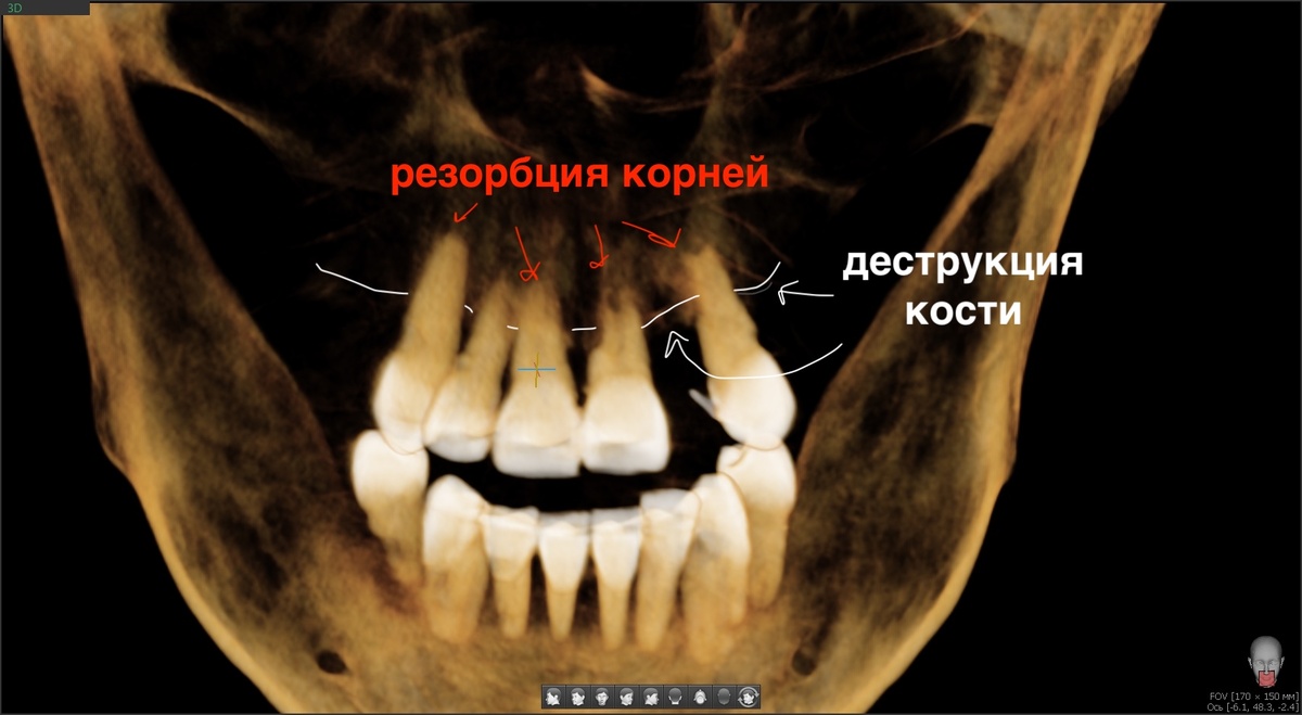 Резорбция корней и деструкция кости