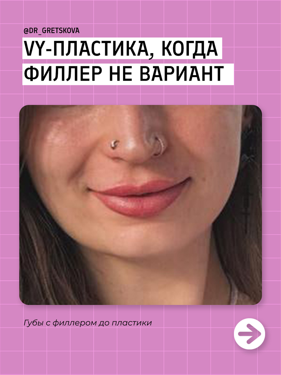 VY-пластика - увеличение губ без филлеров и навсегда / Санкт-Петербург пластический хирург Грецкова Евгения Евгеньевна клиника Абриелль