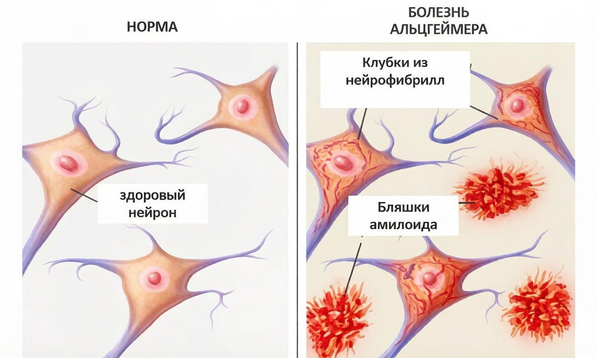 появление бета-амилоида при болезни Альцгеймера